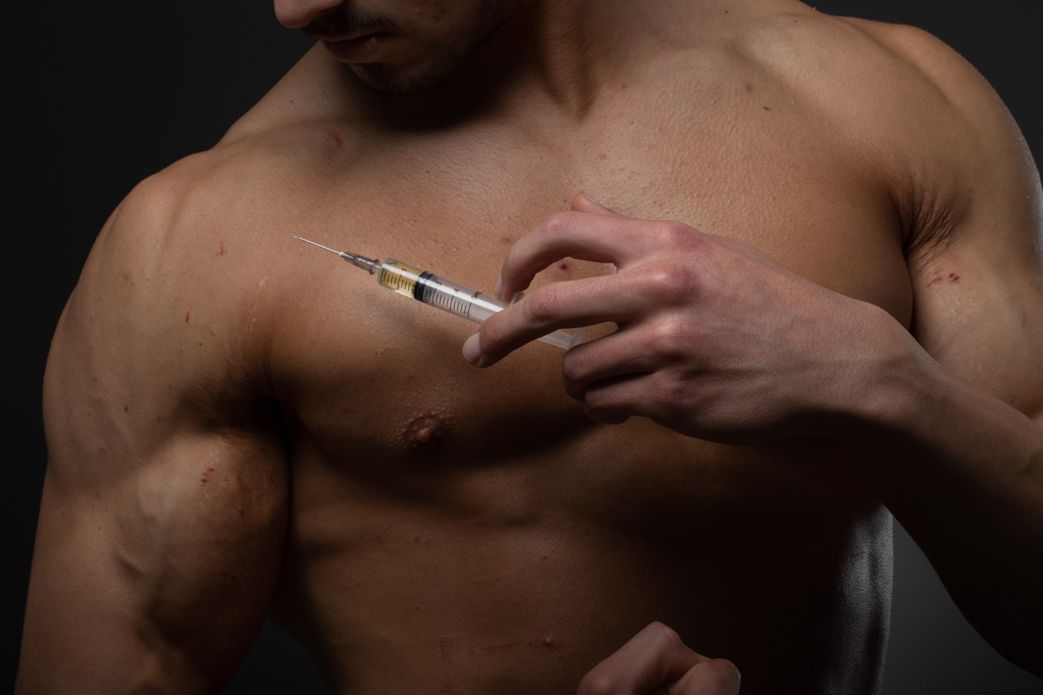 Gynecomastia