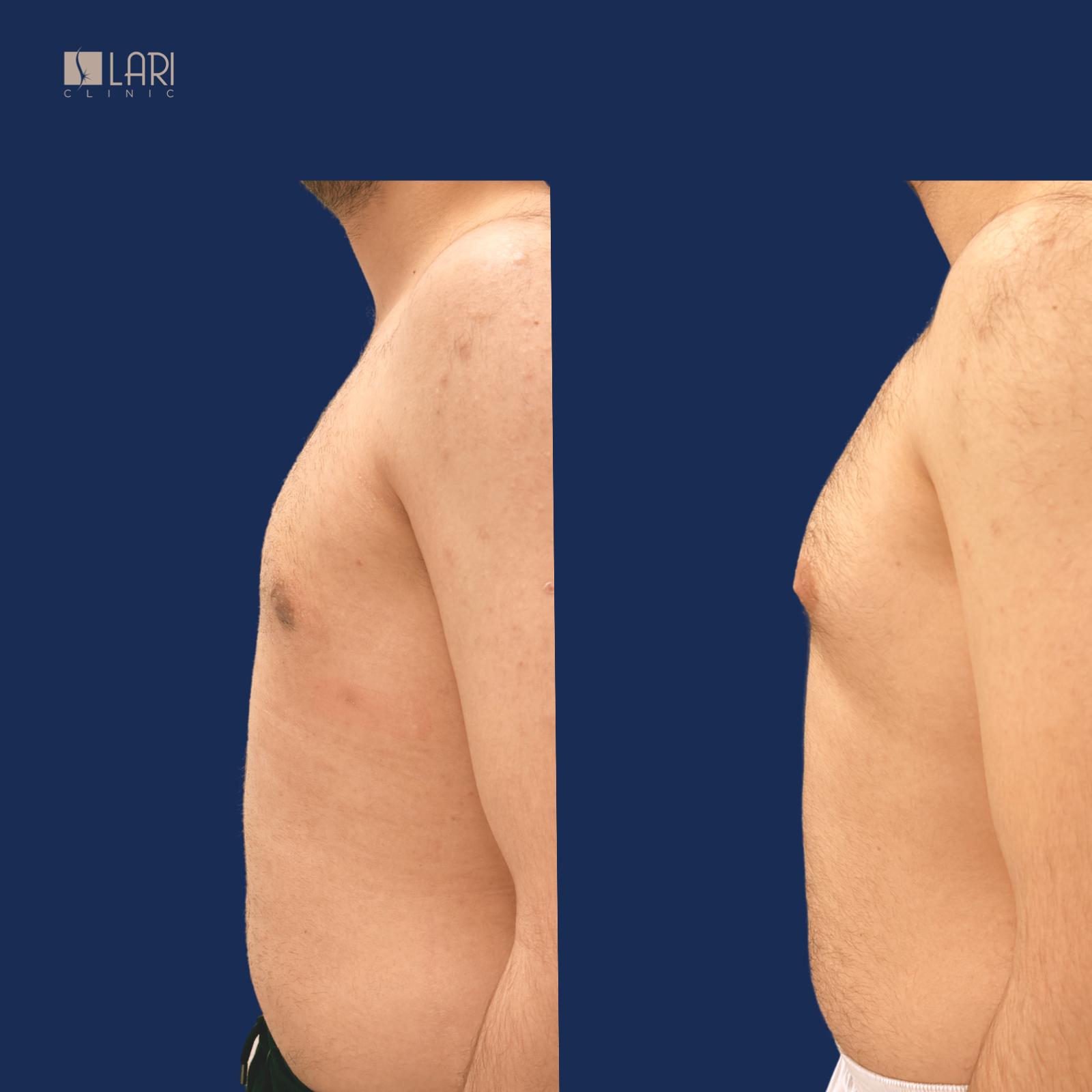 Gynecomastia before and after result 1