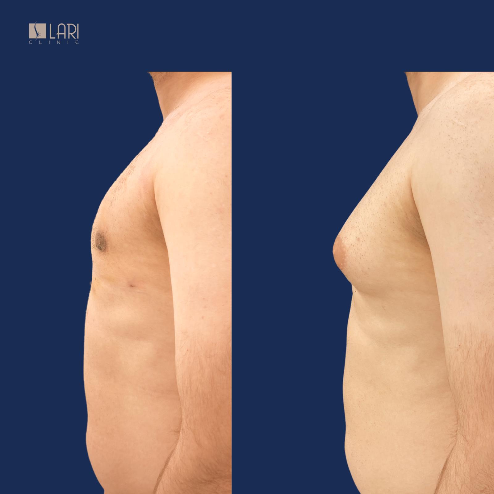 Gynecomastia before and after result 2