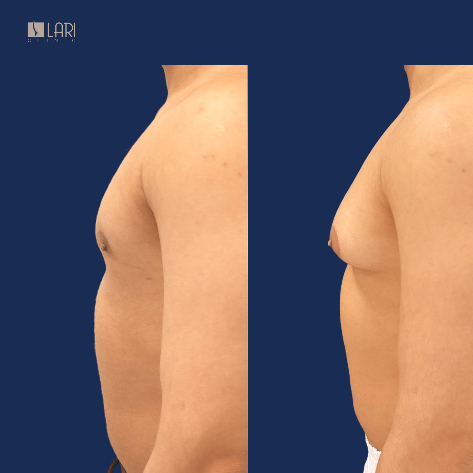 Gynecomastia before and after result 3