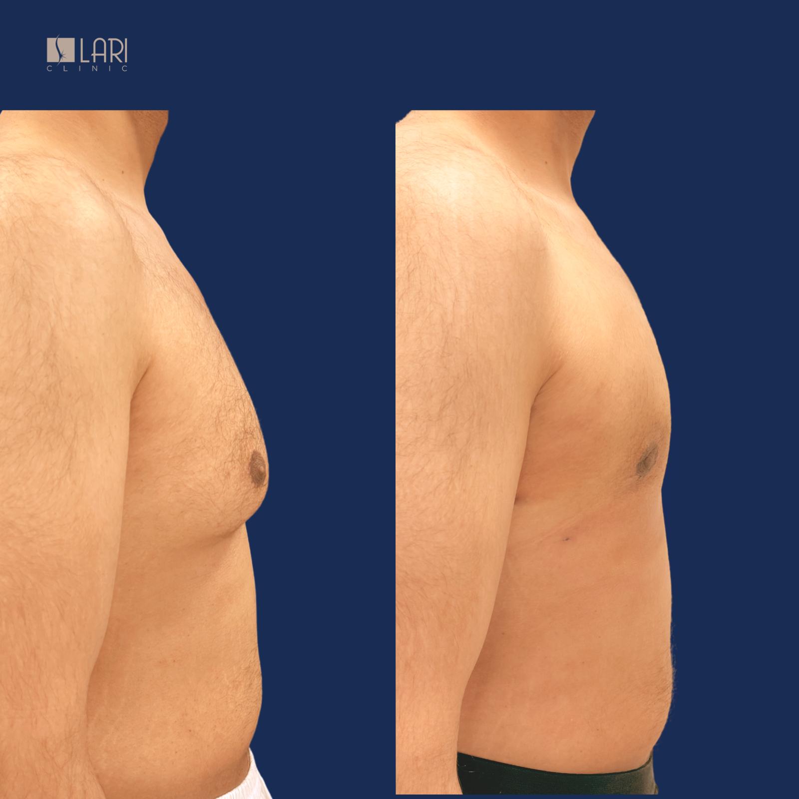 Gynecomastia before and after result 4