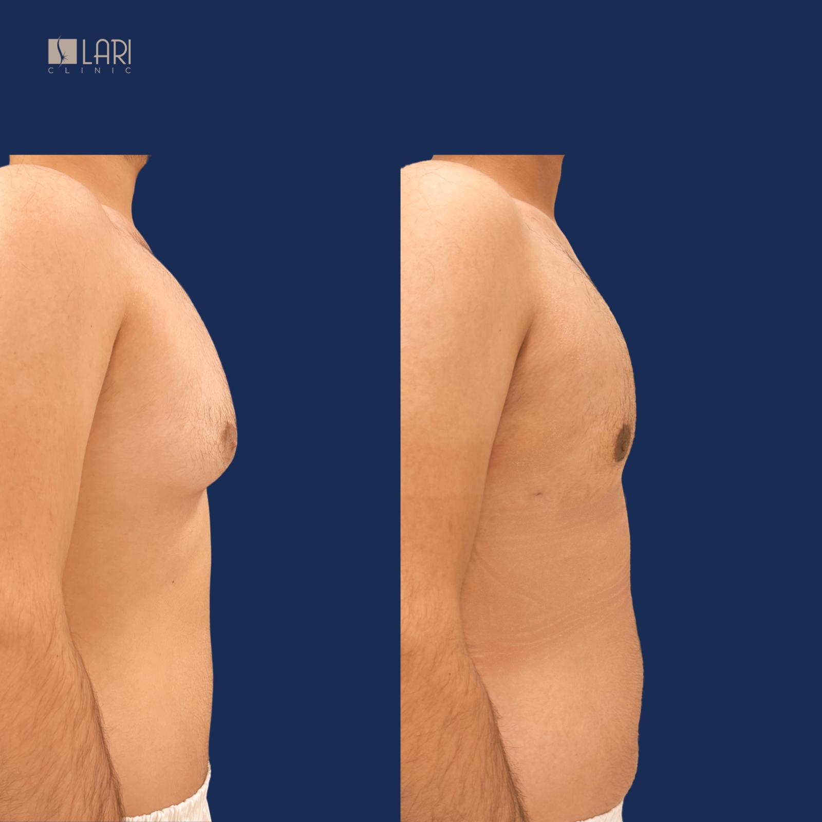 Gynecomastia before and after result 5